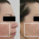 Hyperpigmentation • Baseline and 10 Months
