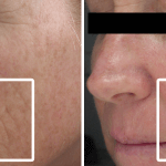 Fine Lines & Wrinkles • Baseline and 1 Month