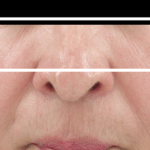 Fine Lines & Wrinkles • Baseline, 1 Month, and 4 Months