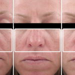 Fine Lines & Wrinkles • Baseline, 1 Month, and 5 Months