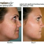 melanage 2