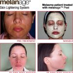 melanage 3