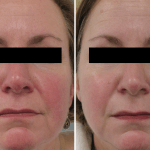 Rosacea • Baseline and 1 Month