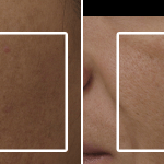 Hyperpigmentation • Baseline and 3 Months