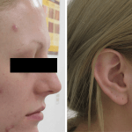 Acne • Baseline and 5 Months