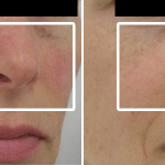 Rosacea • Baseline and 8 Months