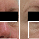 Rosacea • Baseline and 1 Month