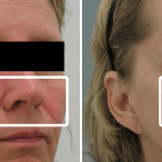 Rosacea • Baseline and 5 Months