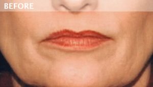 lip augmentation dallas, Lip Augmentation