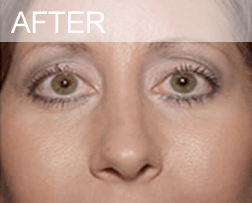 eye lid surgery dallass