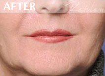 , Restylane and Juvederm