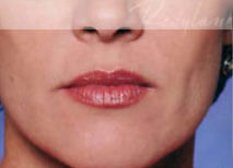, Restylane and Juvederm